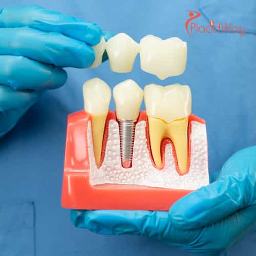 Capitalizing on EU Cross-Border Care: German Medical Tourists Drive Record Demand for Premium Dental Crowns in Croatia